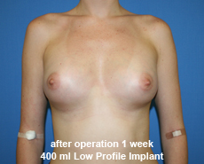 plastic-surgery-breast-augmentation